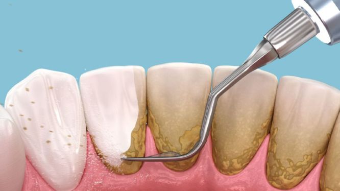 Ilustración de un procedimiento de limpieza dental mostrando la eliminación de sarro de los dientes con un instrumento de ultrasonido